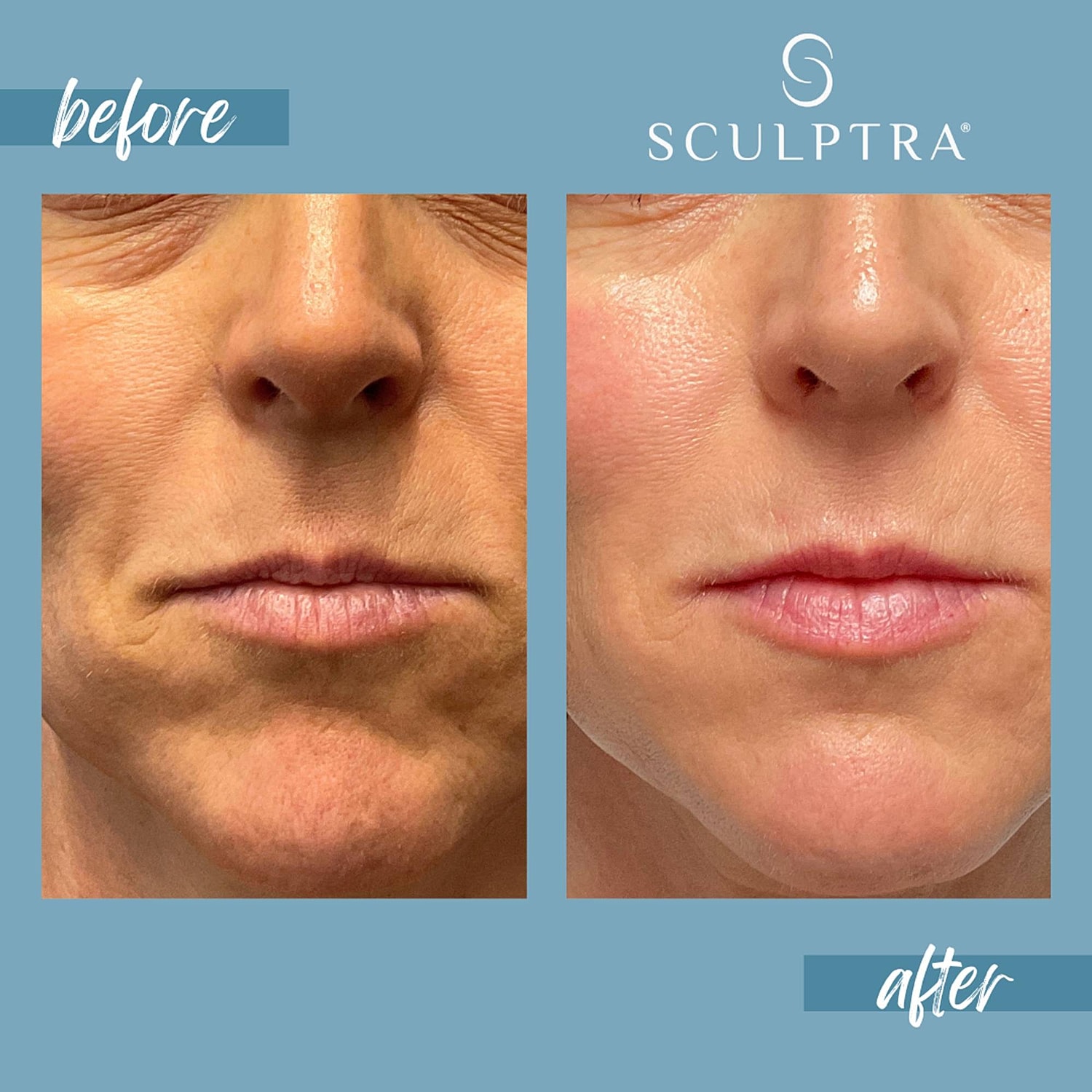 Facial rejuvenation results: before and after Sculptra.