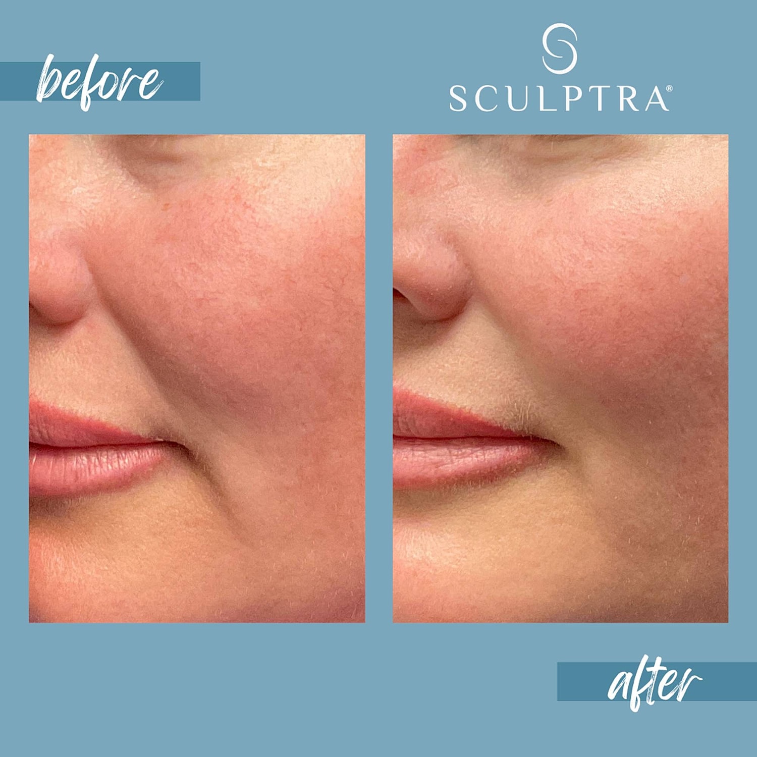 Sculptra treatment: before and after results.