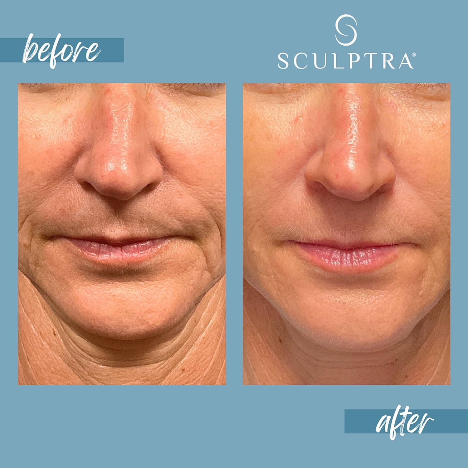 Before and after Sculptra treatment comparison.