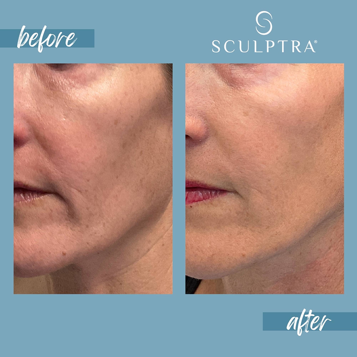 Before and after Sculptra treatment results.
