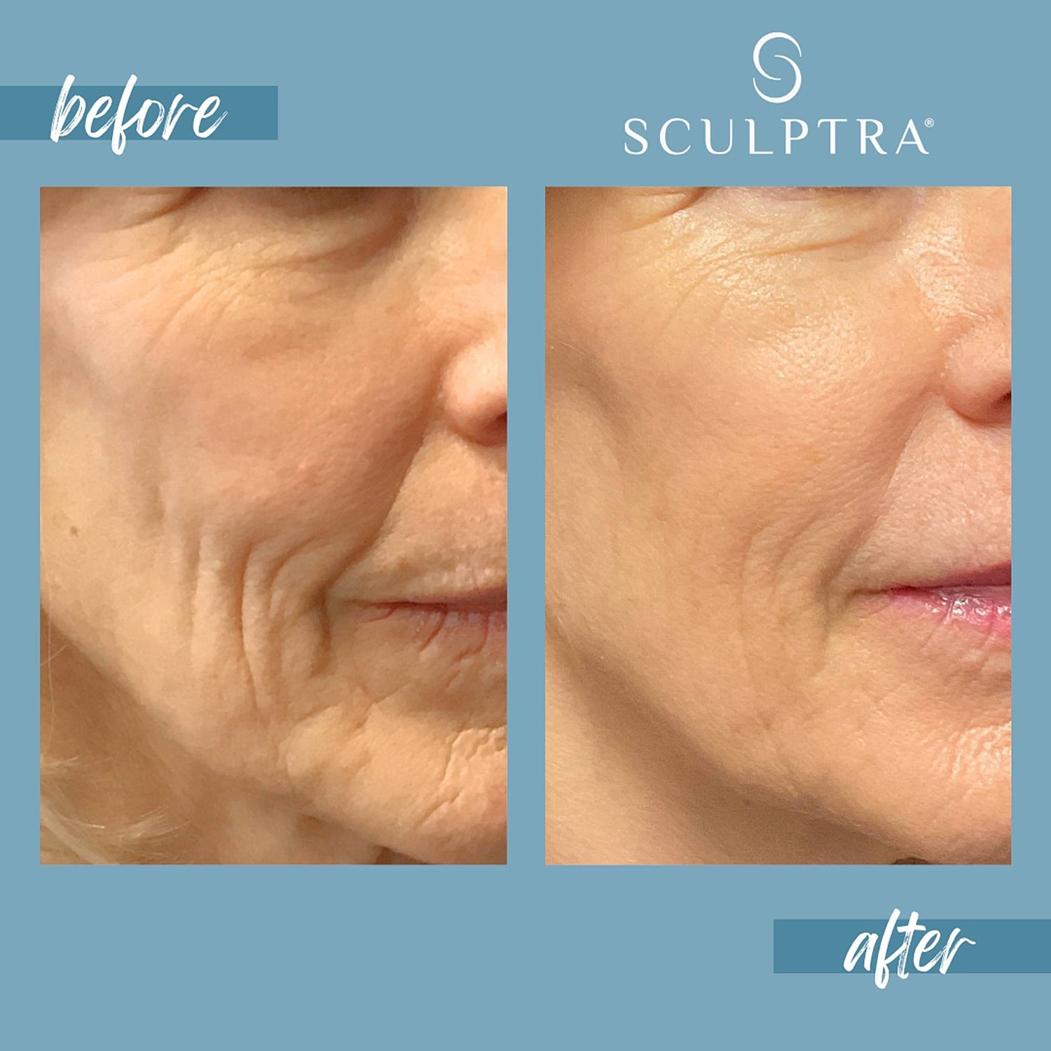 Before and after facial treatment comparison.