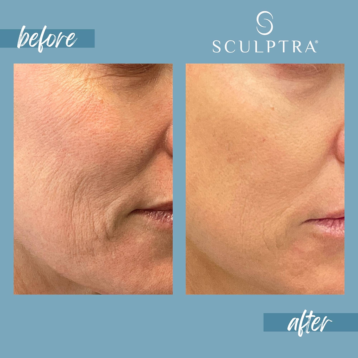 Before and after Sculptra treatment results