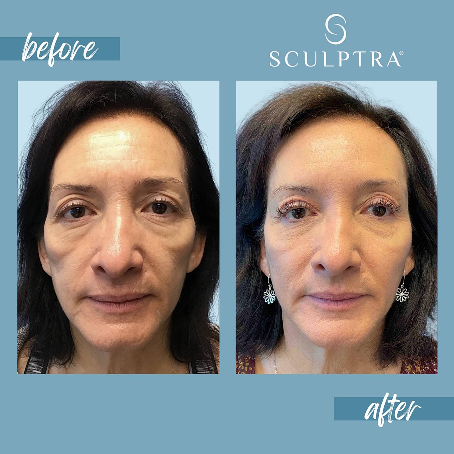 Before and after Sculptra treatment results comparison.