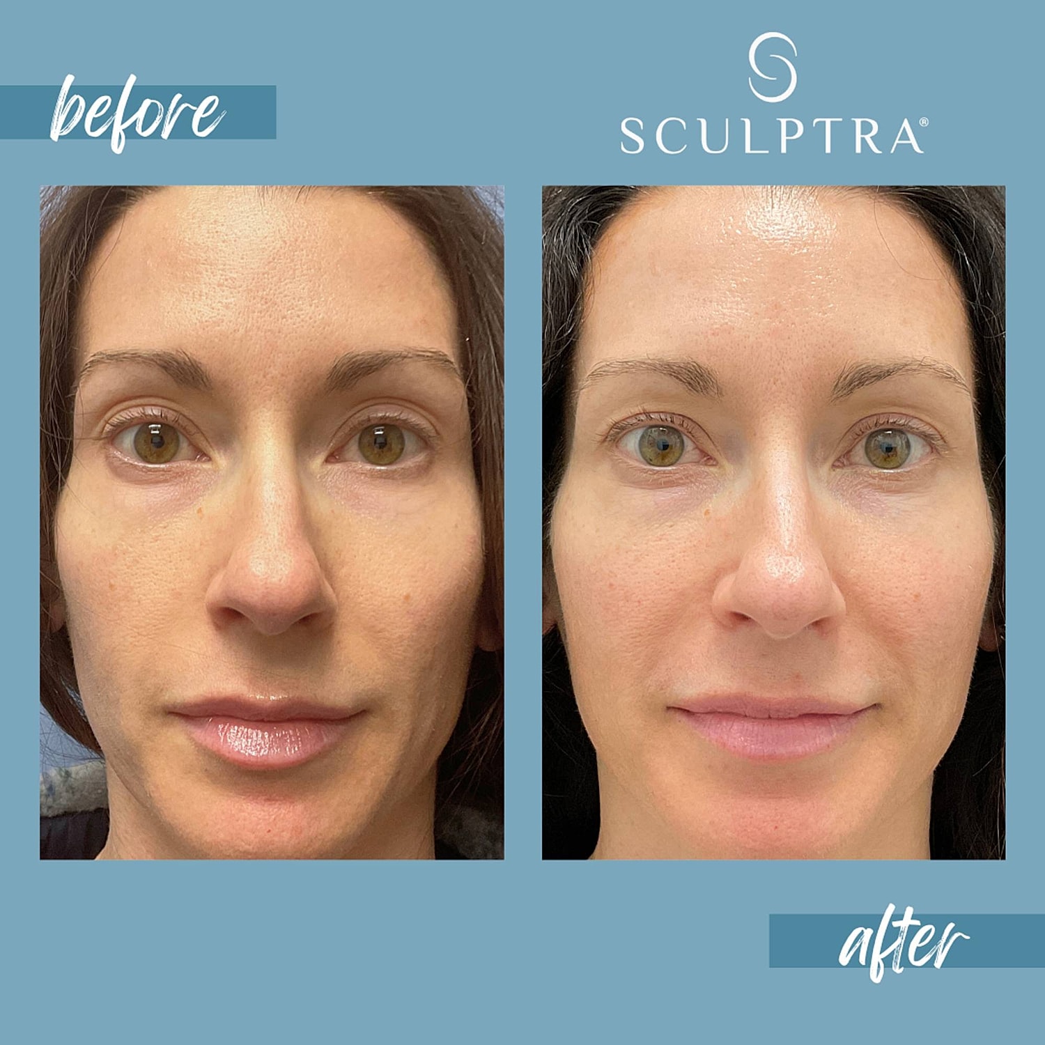 Before and after Sculptra treatment comparison.