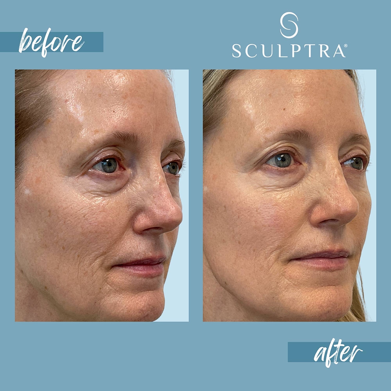 Before and after Sculptra treatment results.