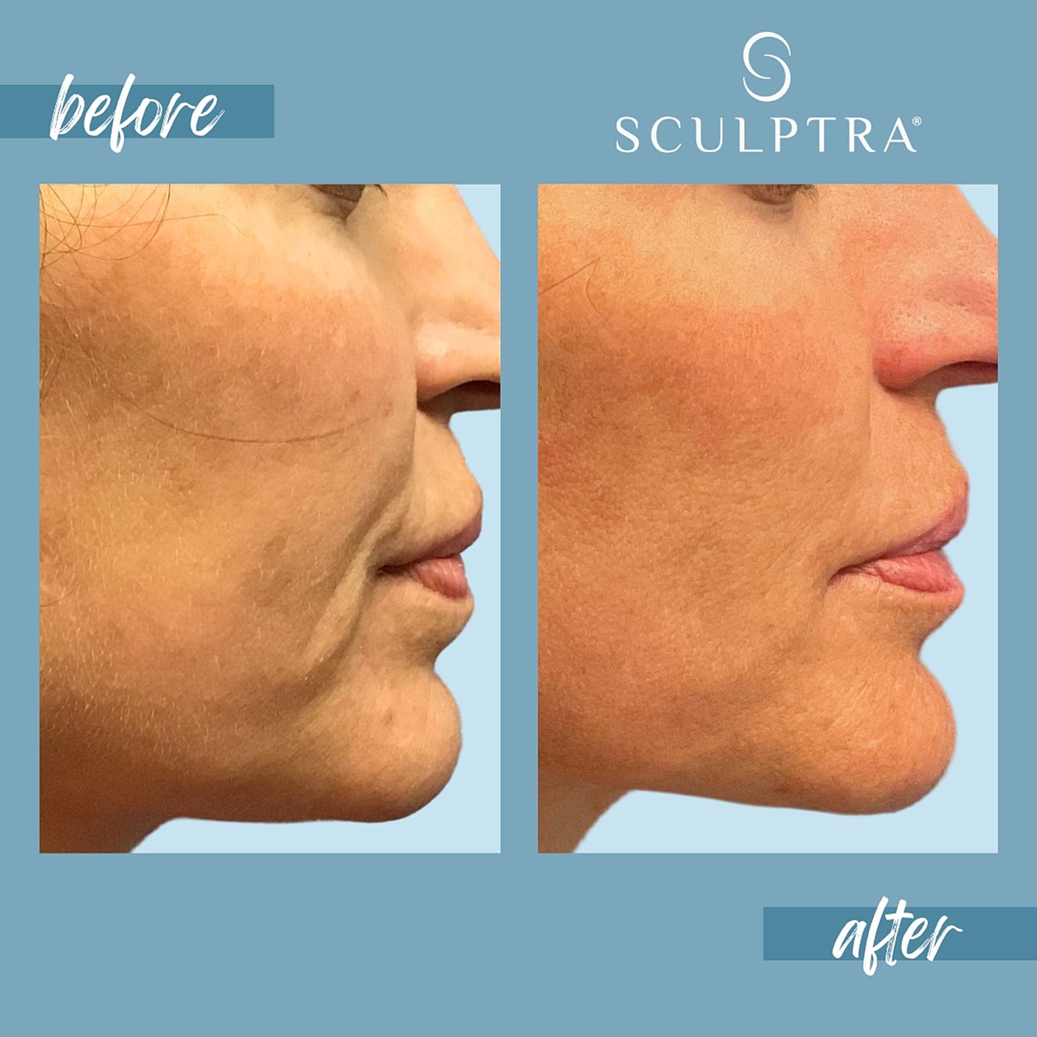 Before and after Sculptra treatment results.