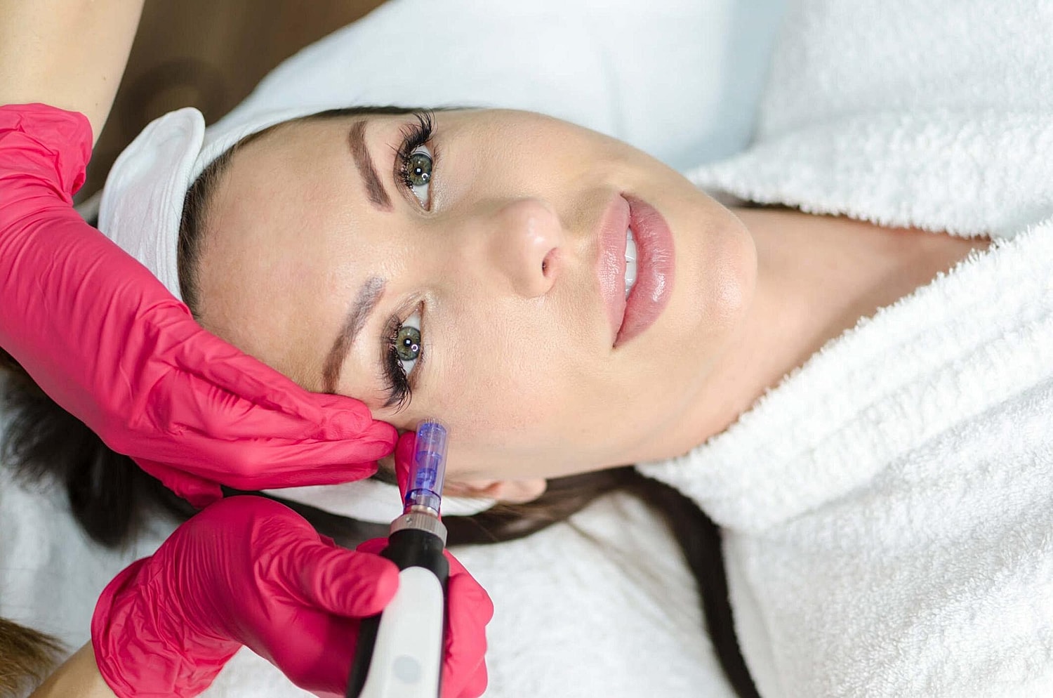 Microneedling treatment on a woman's face.