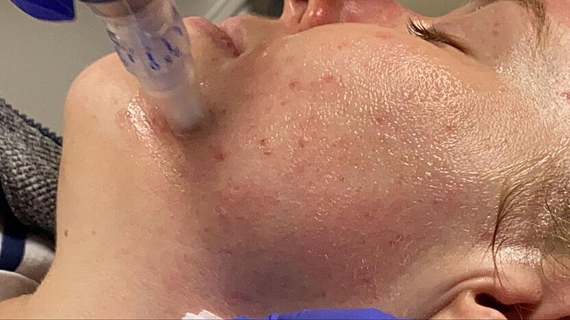 Facial treatment using a microneedling device.
