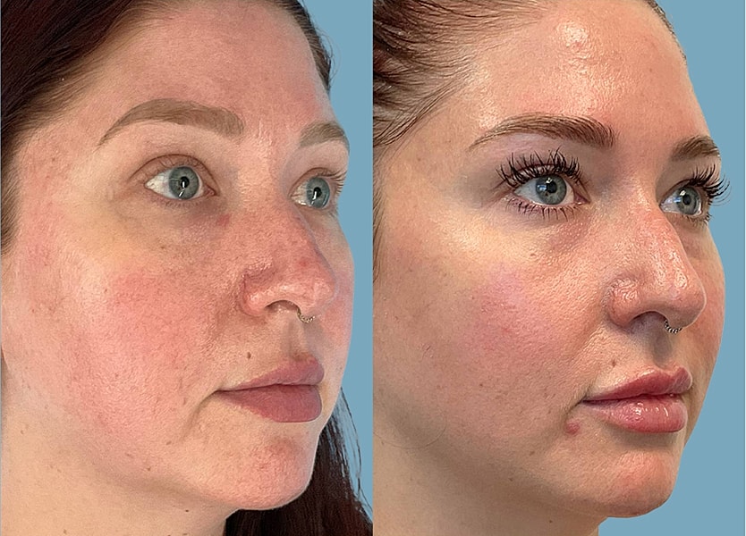 Before and after skincare treatment comparison.