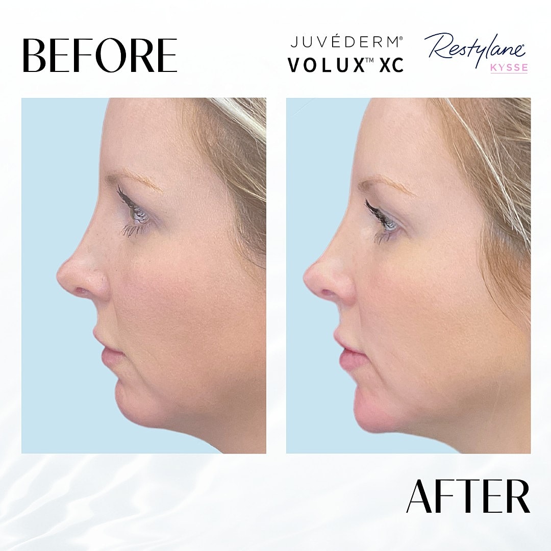 Chin Fillers Before & After