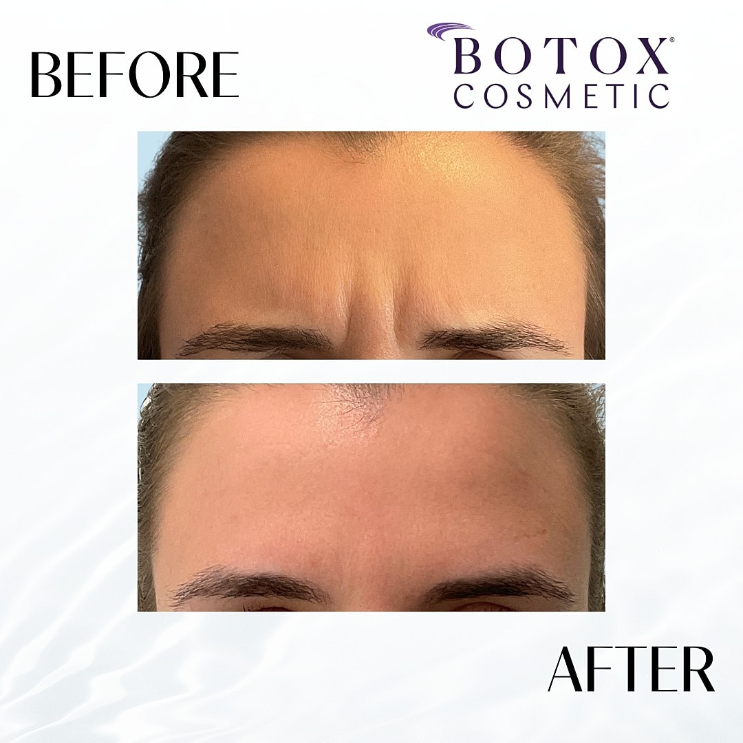 Botox And Dysport Before & After