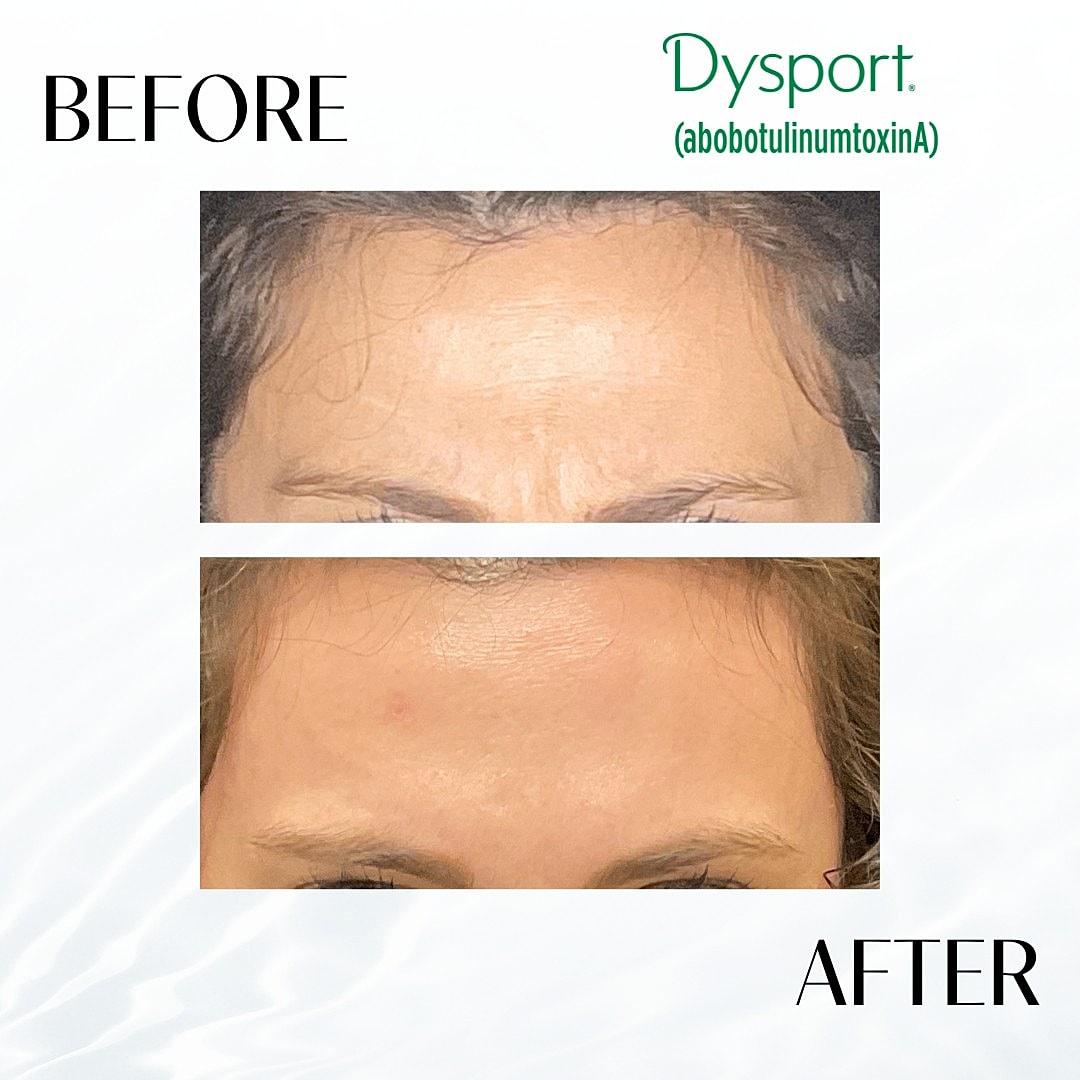 Botox And Dysport Before & After