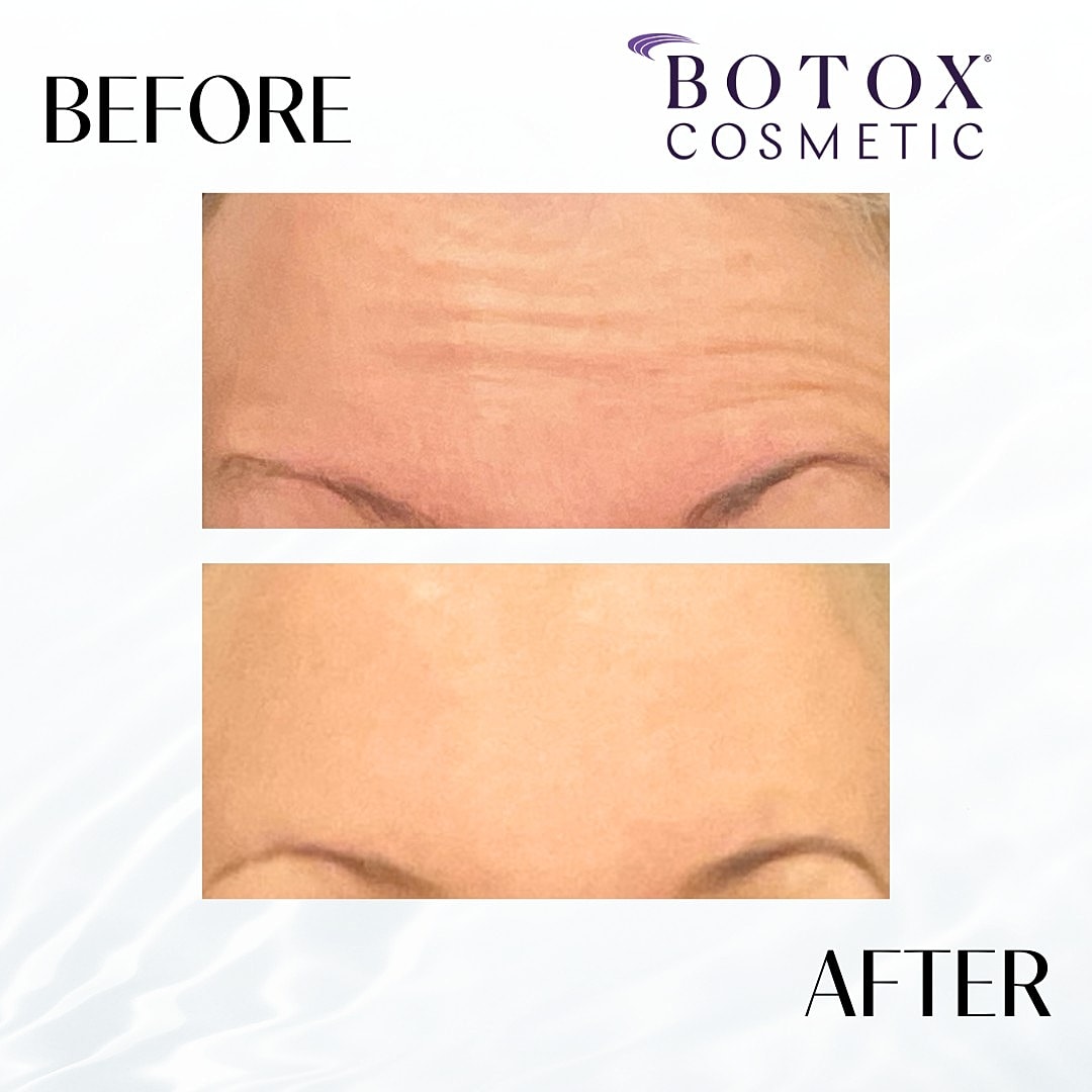 Botox And Dysport Before & After