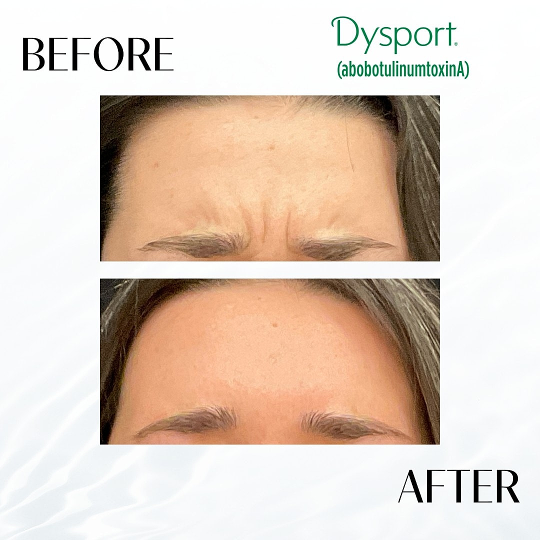 Botox and Dysport Before & After