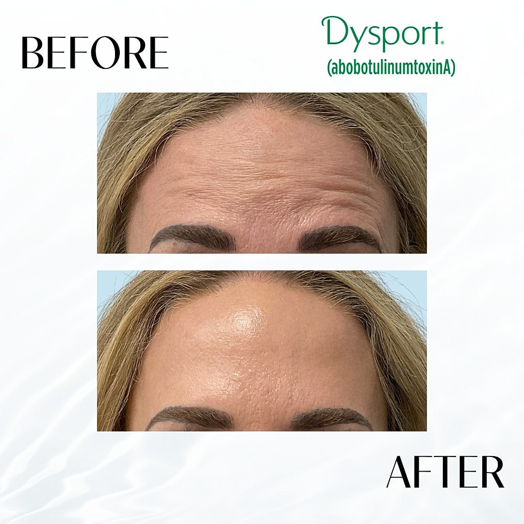 Botox And Dysport Before & After