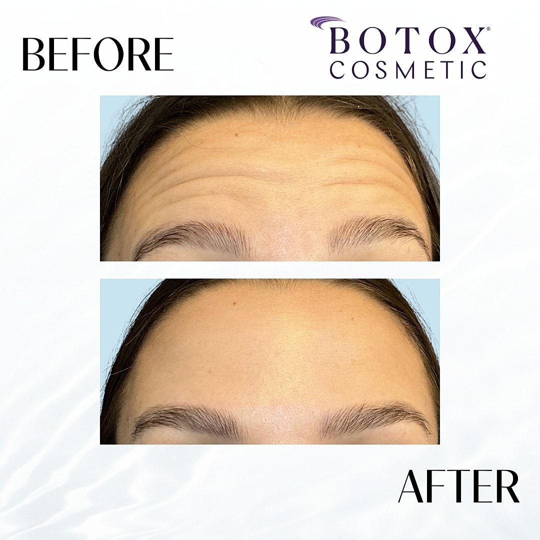 Botox And Dysport Before & After