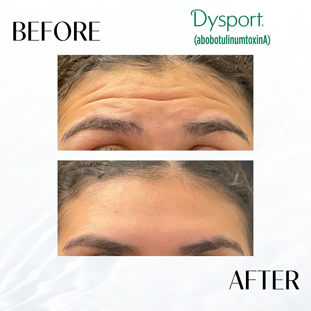 Botox And Dysport Before & After