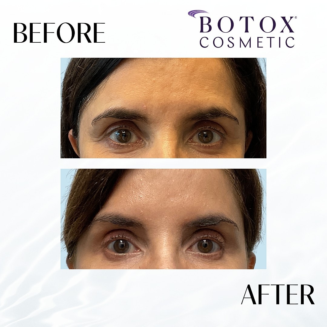 Botox And Dysport Before & After