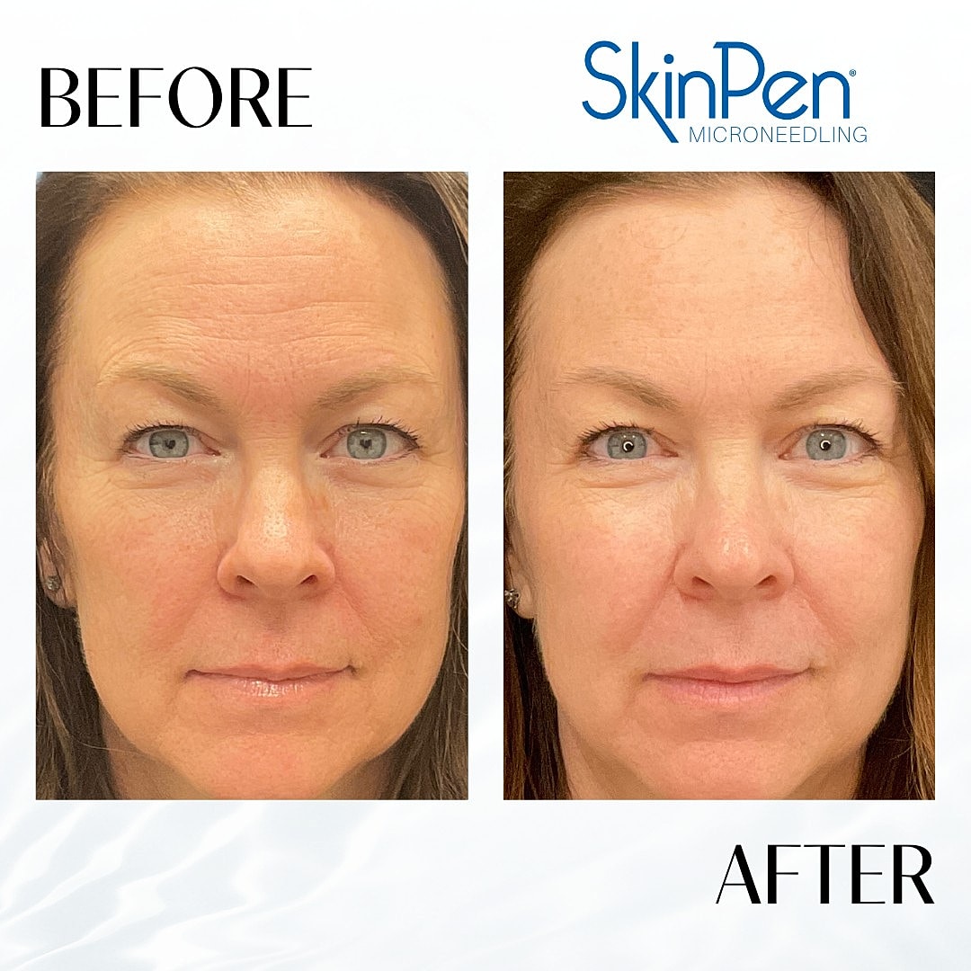 Microneedling Before & After