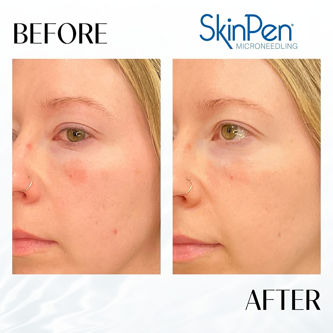 Microneedling Before & After