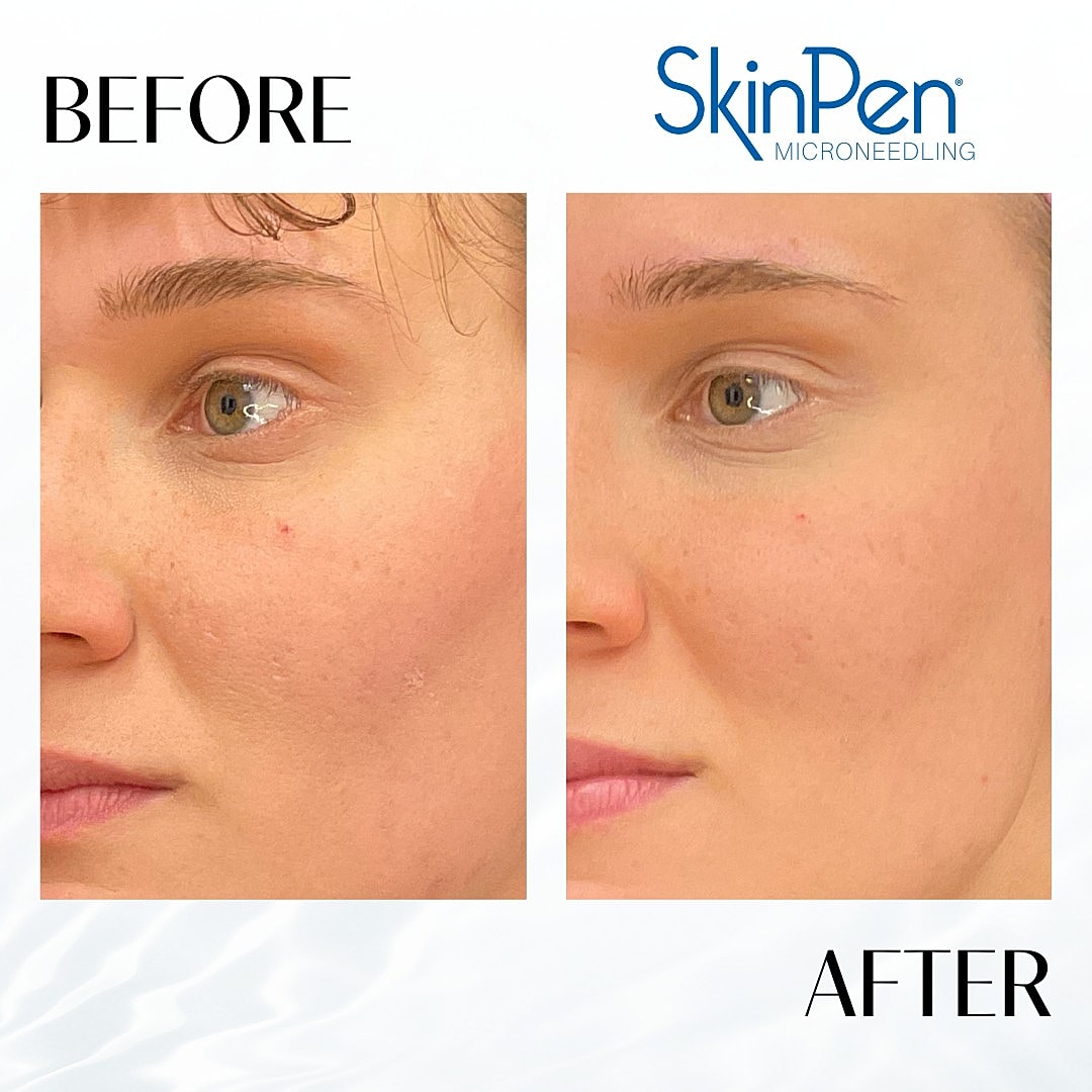 Microneedling Before & After