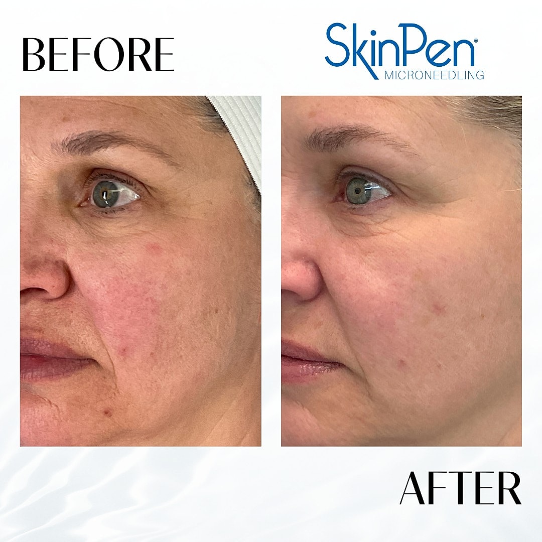 Microneedling Before & After