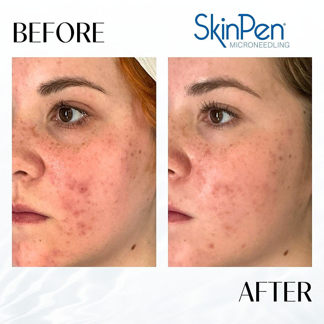 Microneedling Before & After