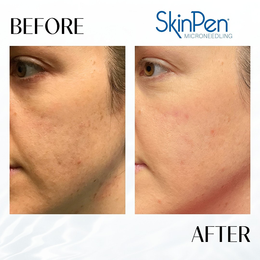 Microneedling Before & After