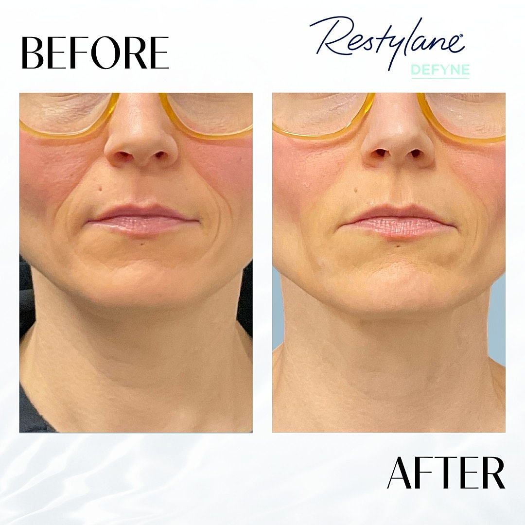 Facial Fillers Before & After