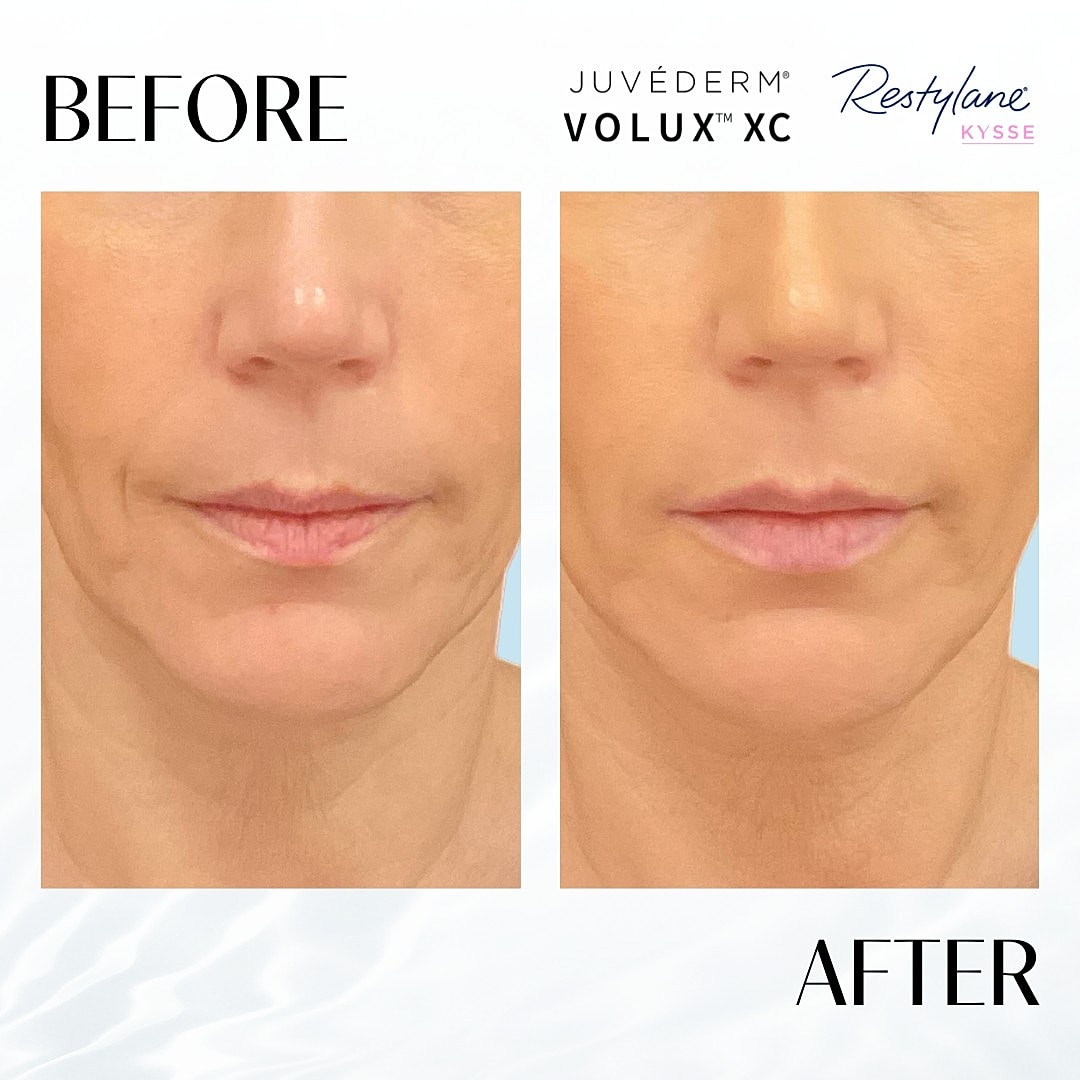 Facial Fillers Before & After