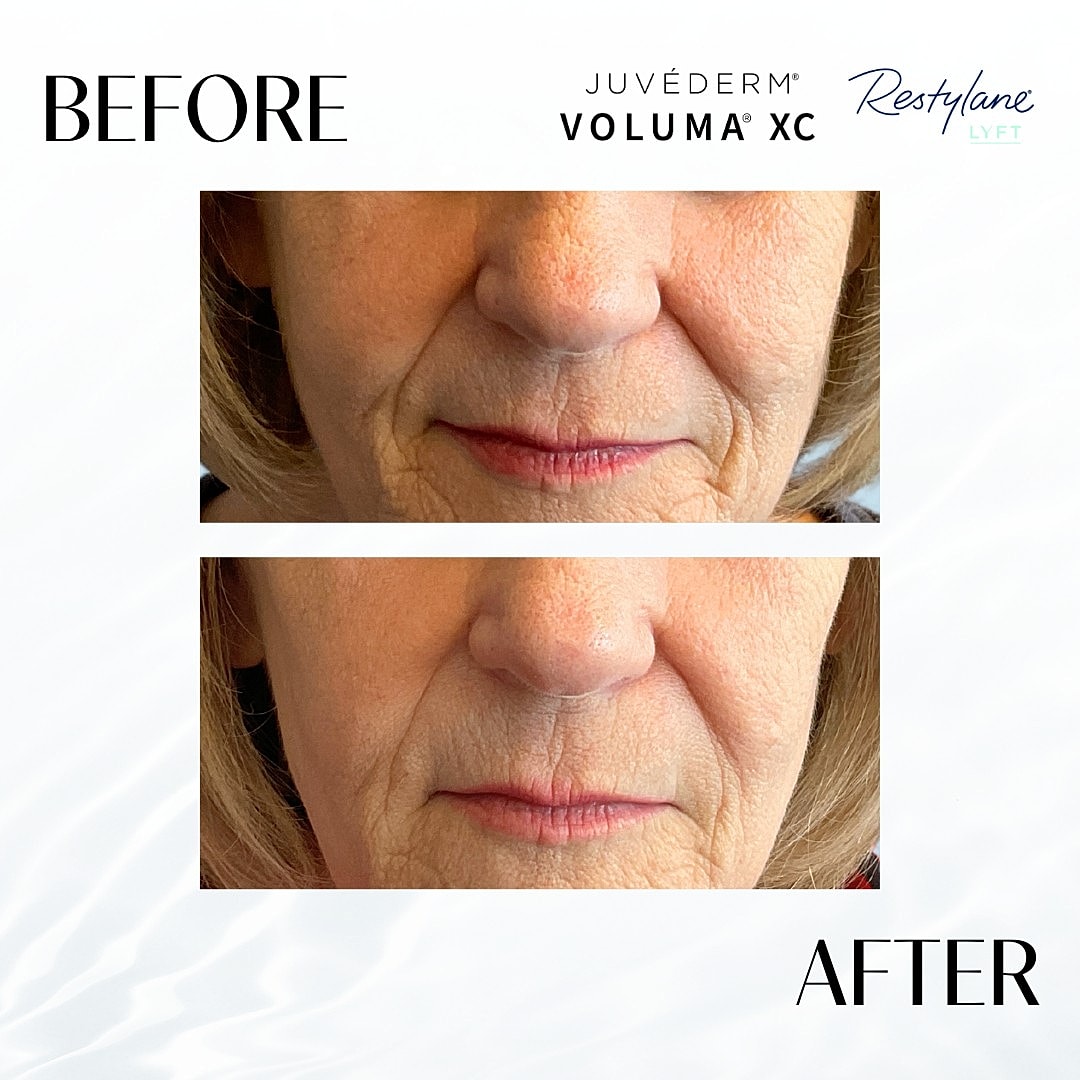 Facial Fillers Before & After