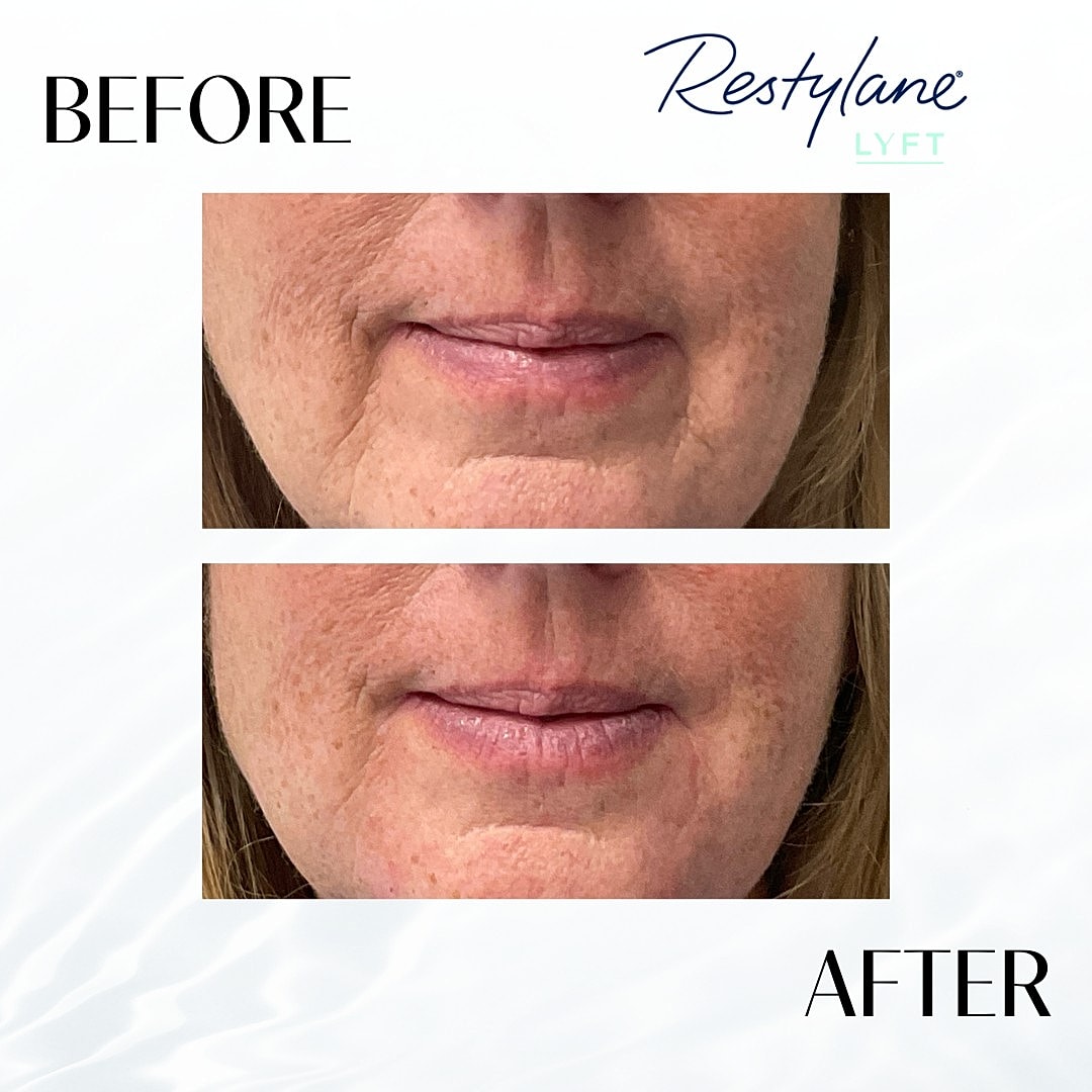 Facial Fillers Before & After