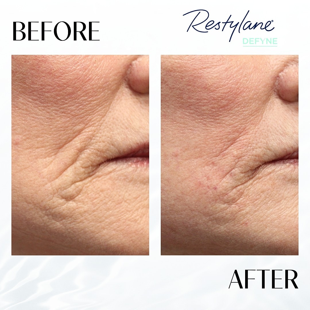 Facial Fillers Before & After