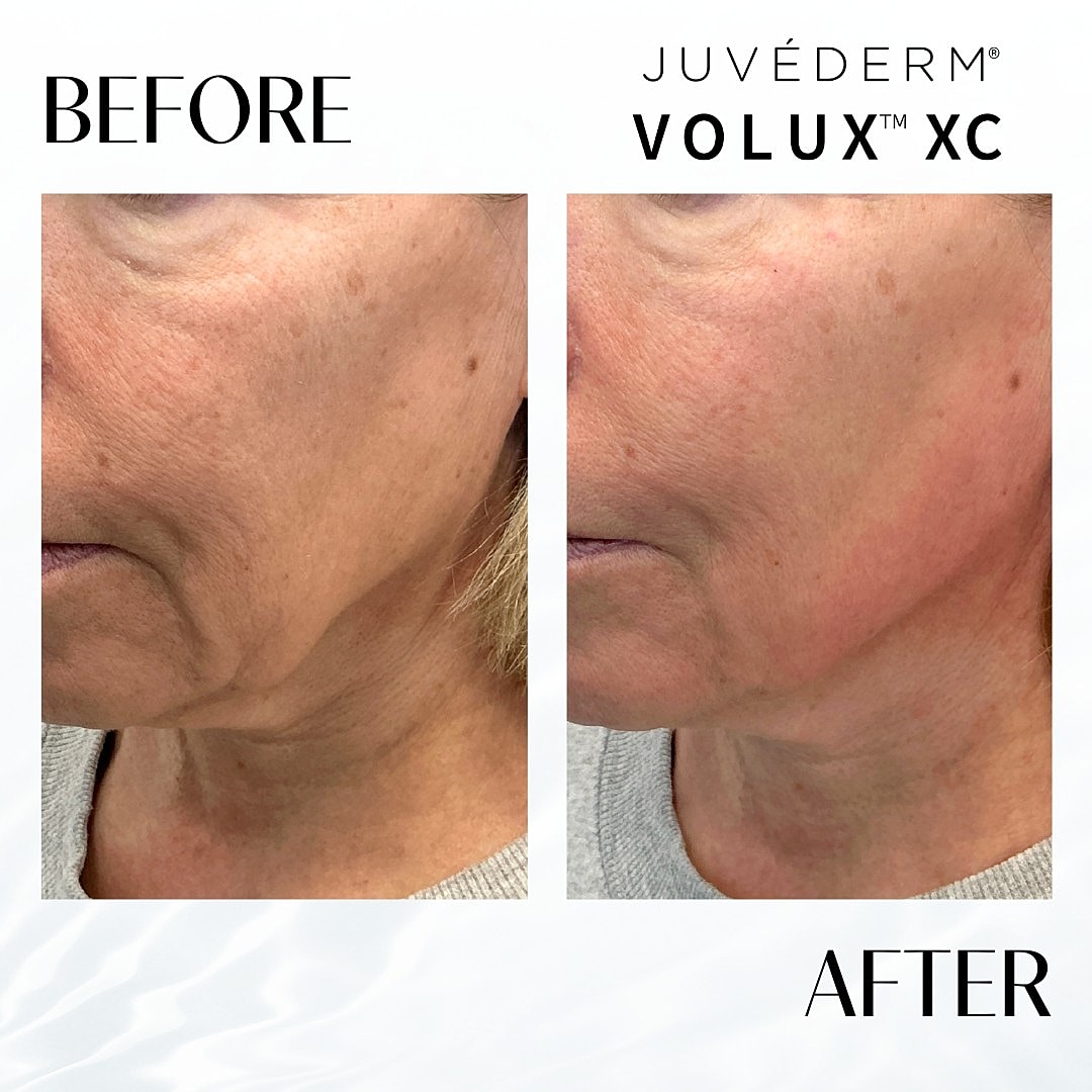 Facial Fillers Before & After