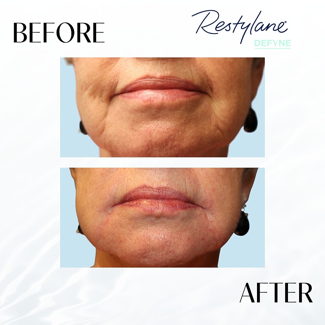 Facial Fillers Before & After