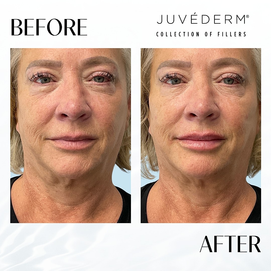 Facial Fillers Before & After