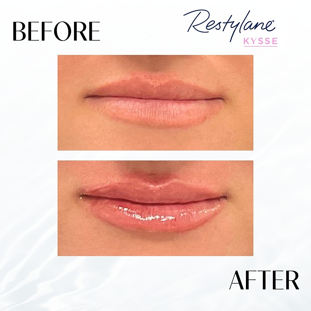 Lip Fillers Before & After