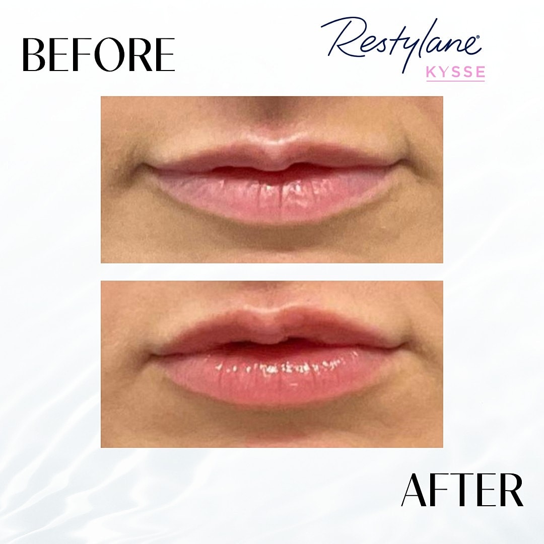 Lip Fillers Before & After