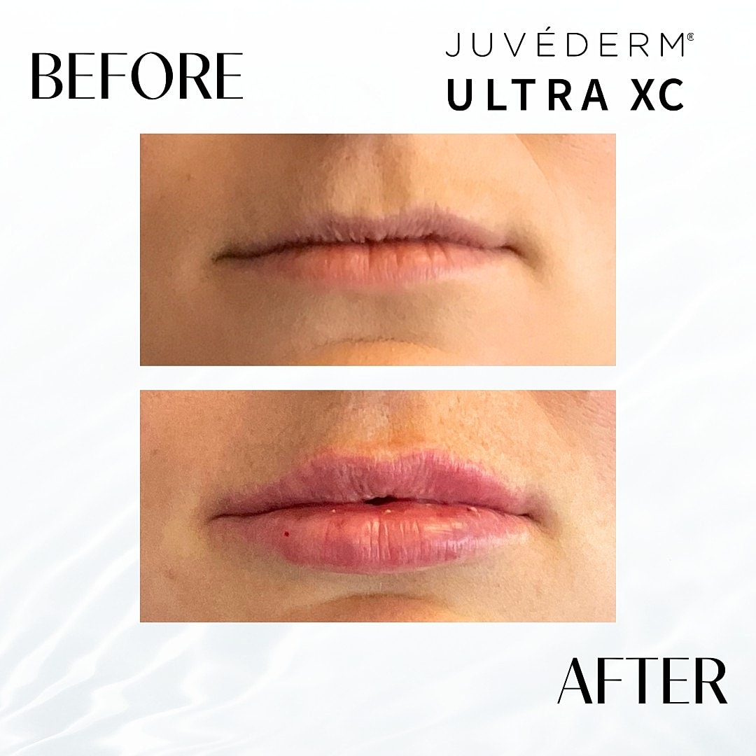 Lip Fillers Before & After