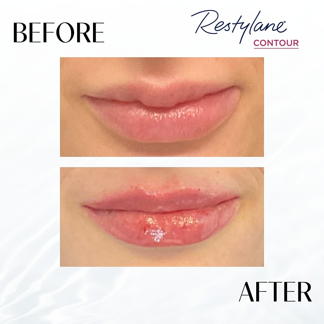 Lip Fillers Before & After