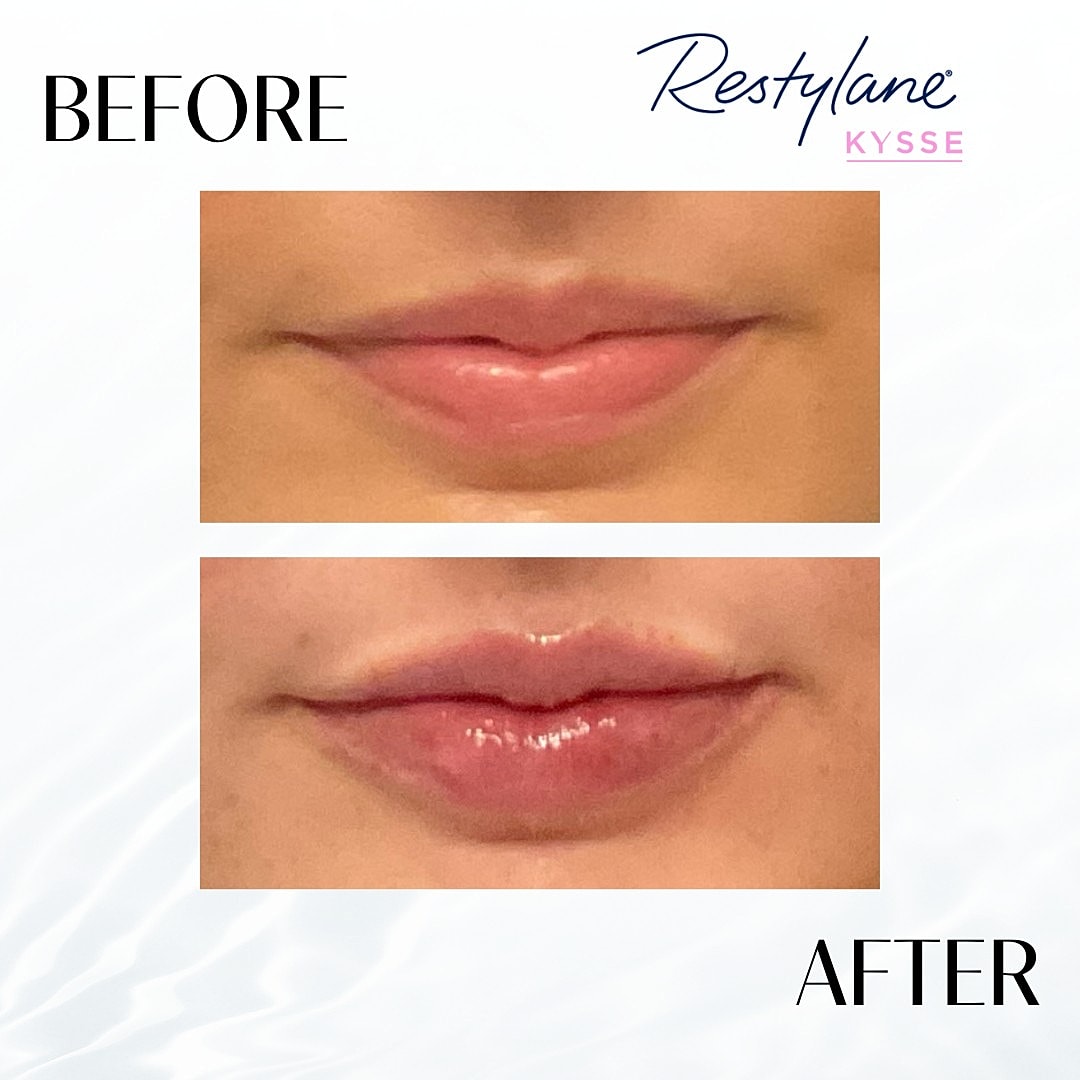 Lip Fillers Before & After