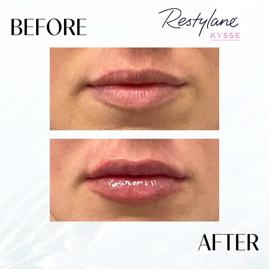 Lip Fillers Before & After