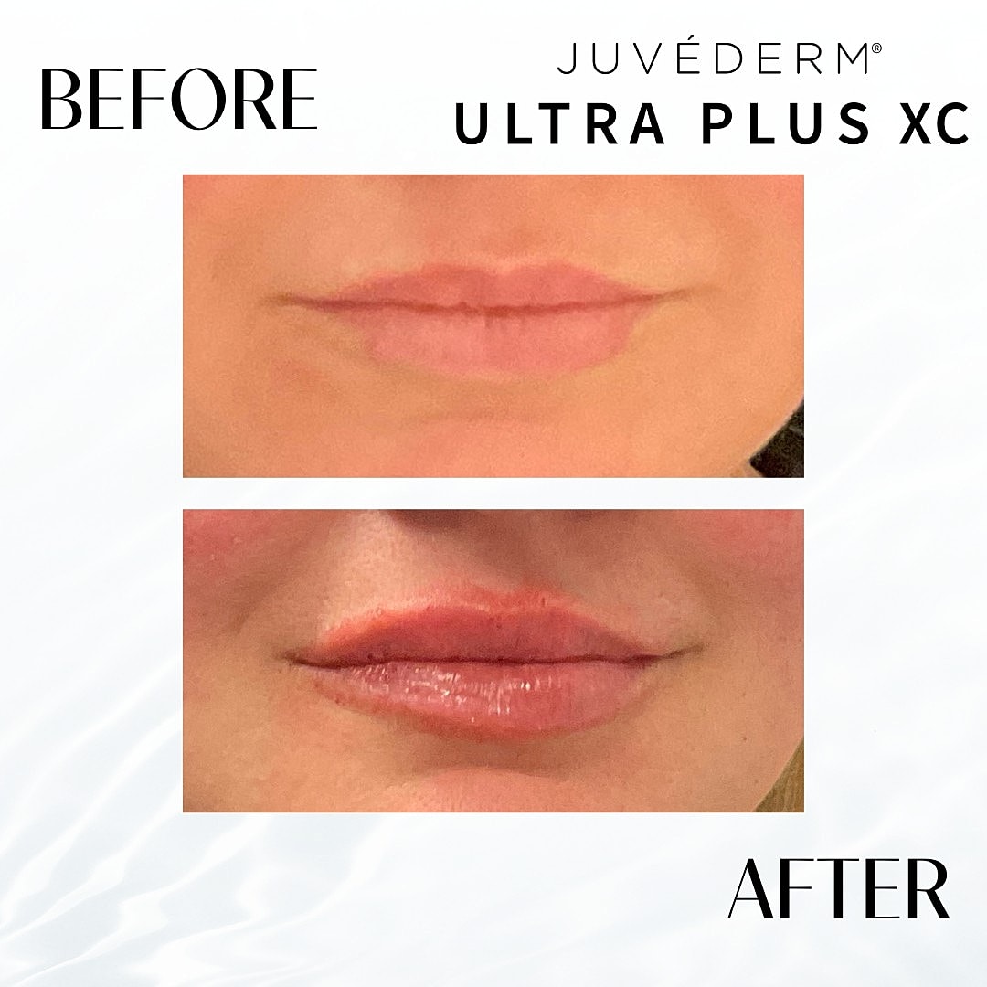 Lip Fillers Before & After