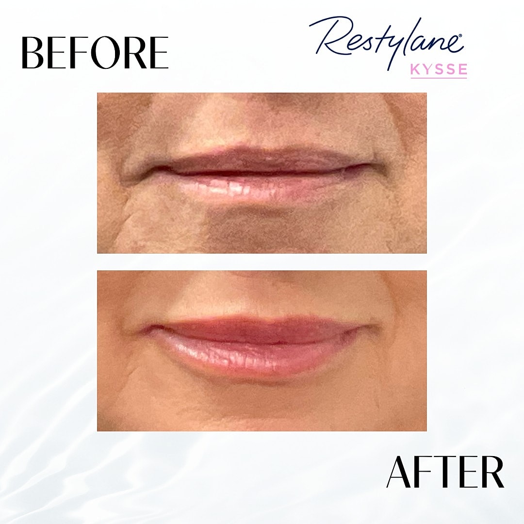 Lip Fillers Before & After