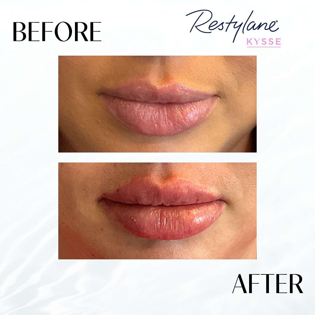 Lip Fillers Before & After
