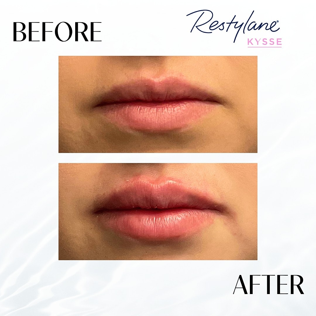 Lip Fillers Before & After