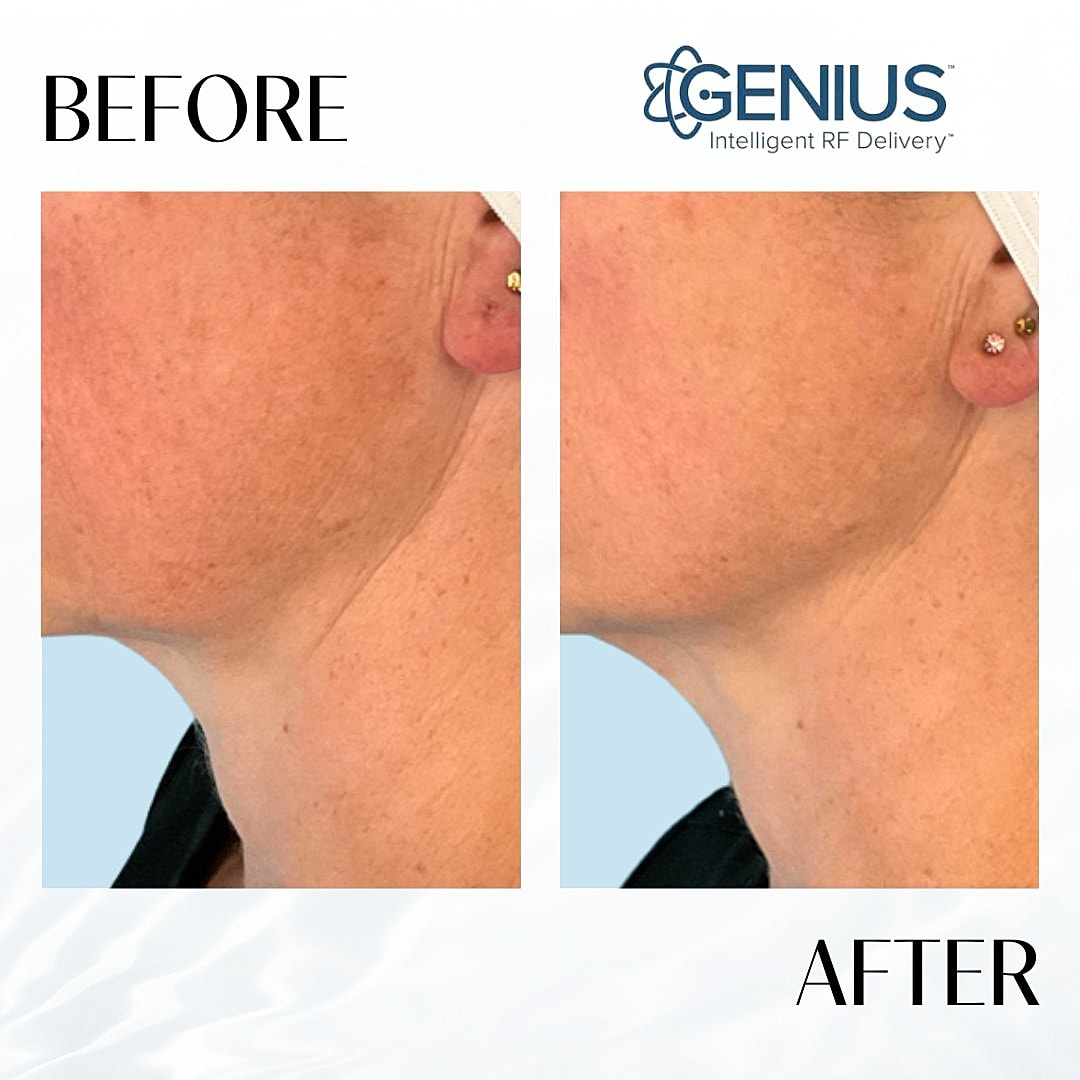 Genius Before & After