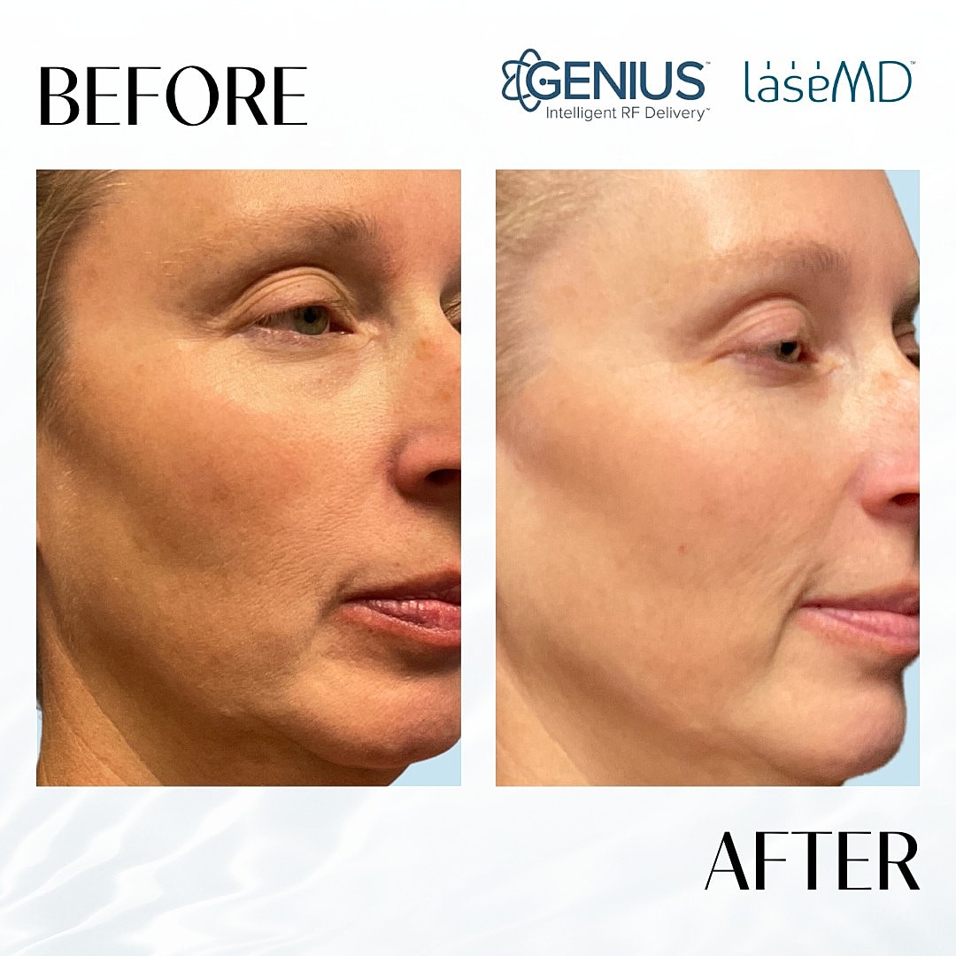 Genius Before & After