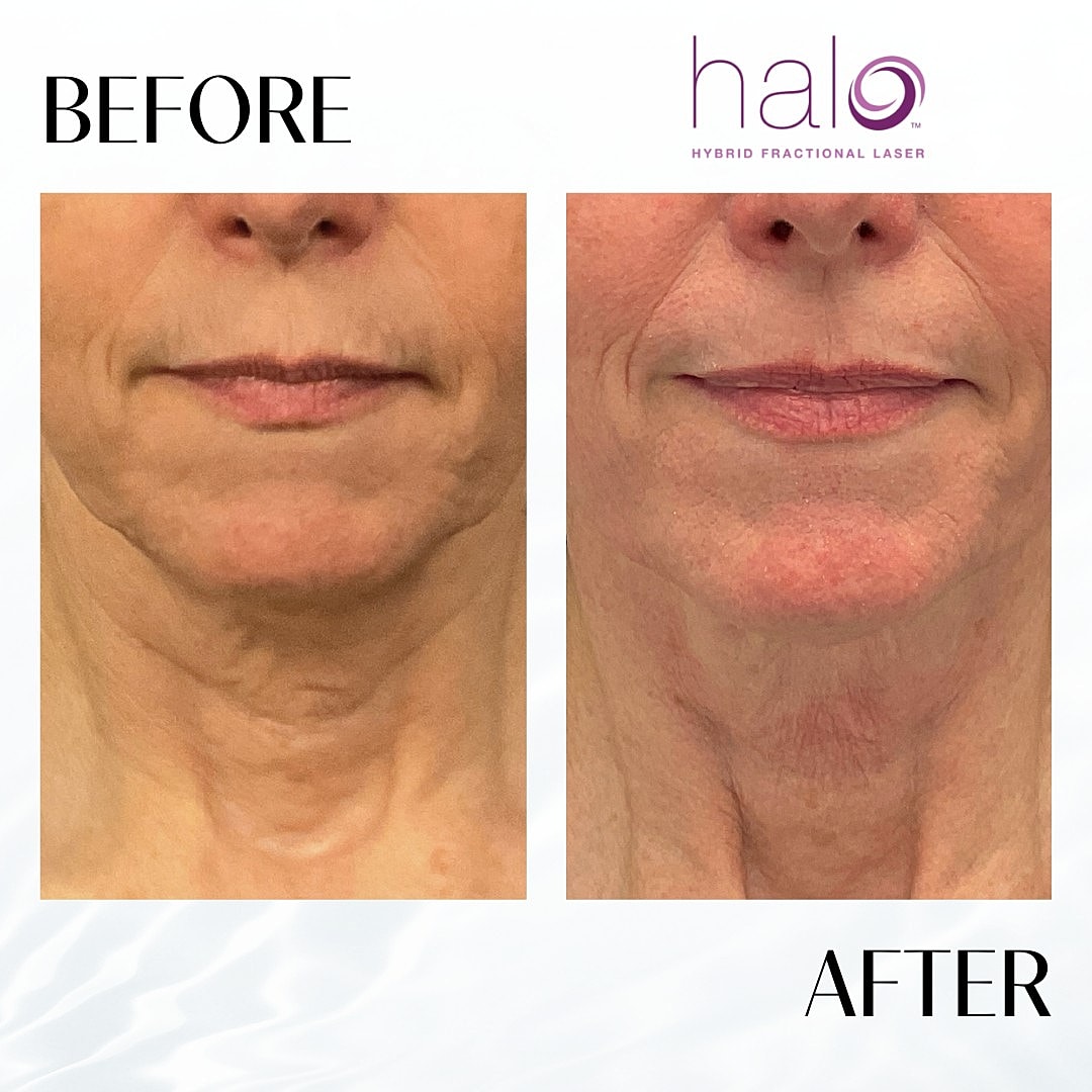 Halo Laser Before & After