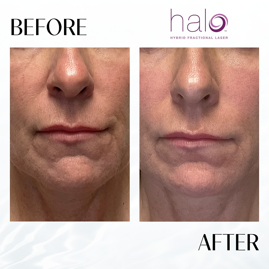 Halo Laser Before & After